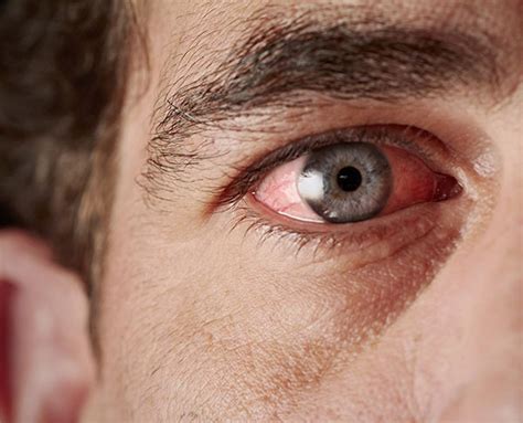 red eyes  symptoms treatment goyal eye