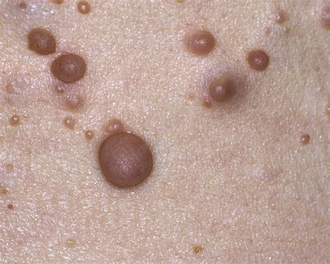 Neurofibromatosis type 2 | Sign Cause Treatment | Optimists Wellness