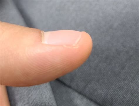 곤봉지손톱인가요? 아니면 위험한건가요 : 지식iN