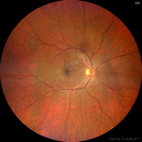 Yasunari Nodules – Neurofibromatosis Type 1 – Retinography