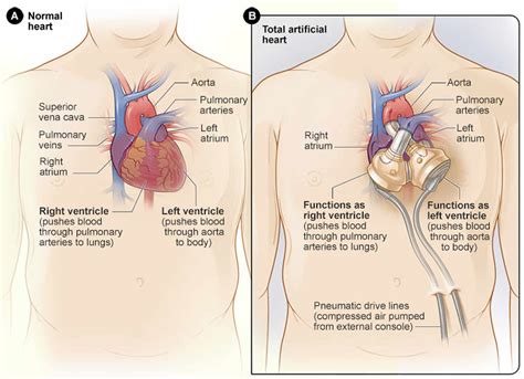 Artificial heart, total artificial heart, complications & life expectancy