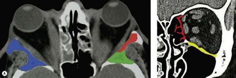 Surgical rehabilitation of Graves’ orbitopathy | Ento Key