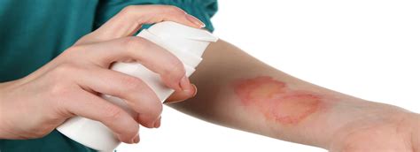 How Much is My Burn Injury Claim Worth? | Pinder Plotkin LLC