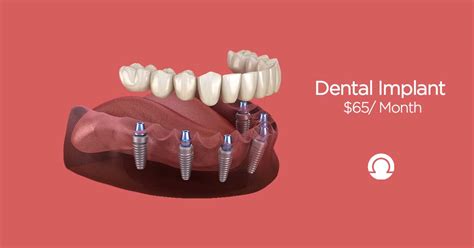 dental implants full mouth