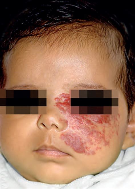 PHACE syndrome: clinical manifestations, diagnostic criteria, and ...