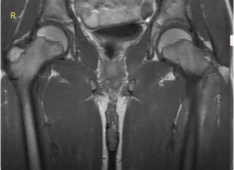Osteomyelitis MRI - wikidoc