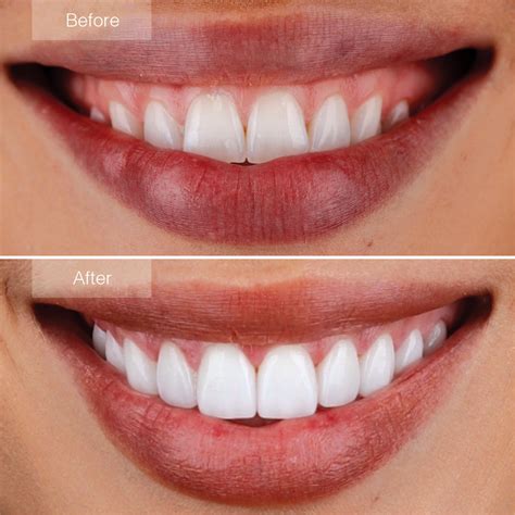 Porcelain Veneers Before and After - The Dental Room