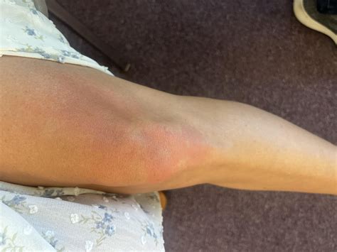 Red splotches all over : r/HistamineIntolerance
