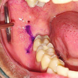 Incision marking for the surgical removal of the impacted mandibular ...