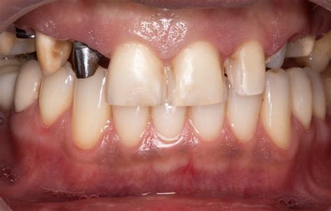 Implantes dentales ️ Restaura tu sonrisa, Medellín