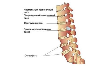 Болит шея при повороте головы? Как лечить боль в шее?