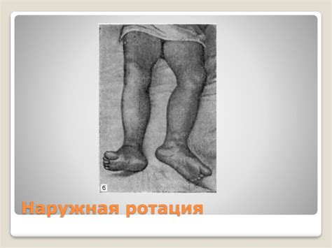 Переломы бедренной кости - презентация онлайн