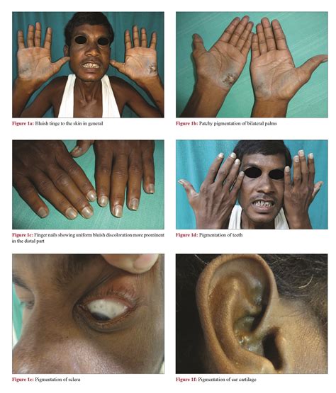 Blue palms and nails: A clue to diagnosis of alkaptonuria - Indian