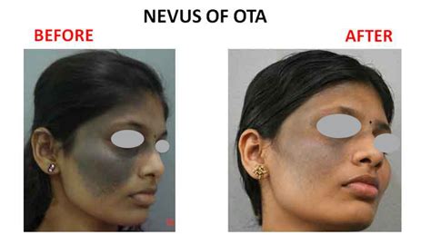 Nevus Of Ota – Amrit Clinic