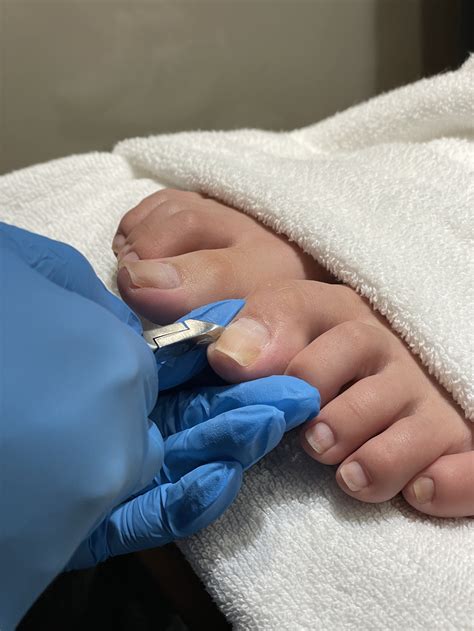 Learn what ingrown toenails are and how to prevent them — Onyx ...
