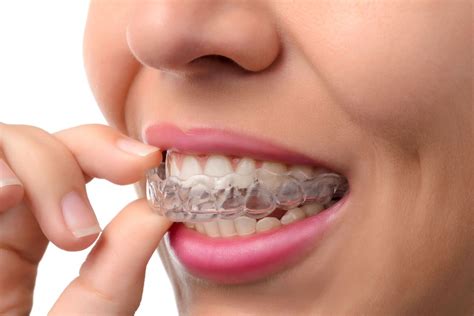 how much does it cost to get invisalign without insurance