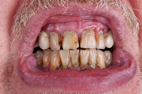 Meth Mouth: What It Looks Like and How to Treat It