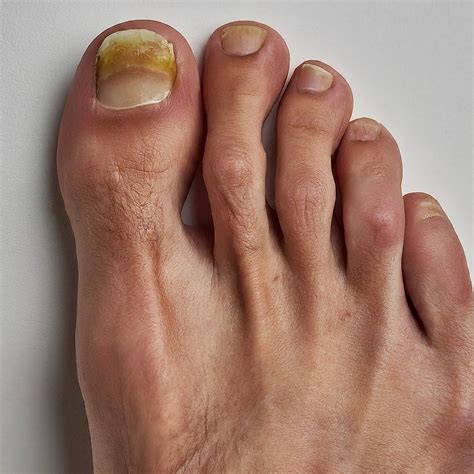 Early Stage Toenail Fungus: Don't Ignore The Warning Signs