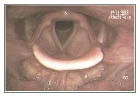 diagram  laryngeal vestibule diagram quizlet