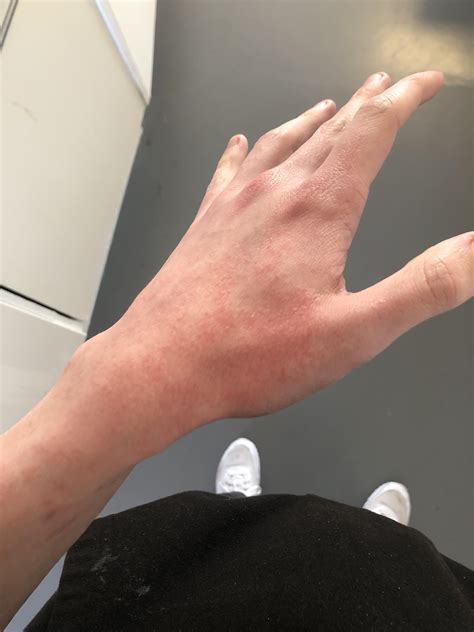 Sunburn Blisters On Nose
