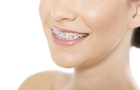 Is Pink a Good Color for Braces? - The Braces Guide