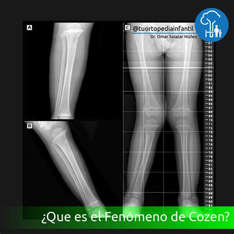 ¿Que es el Fenómeno de Cozen?