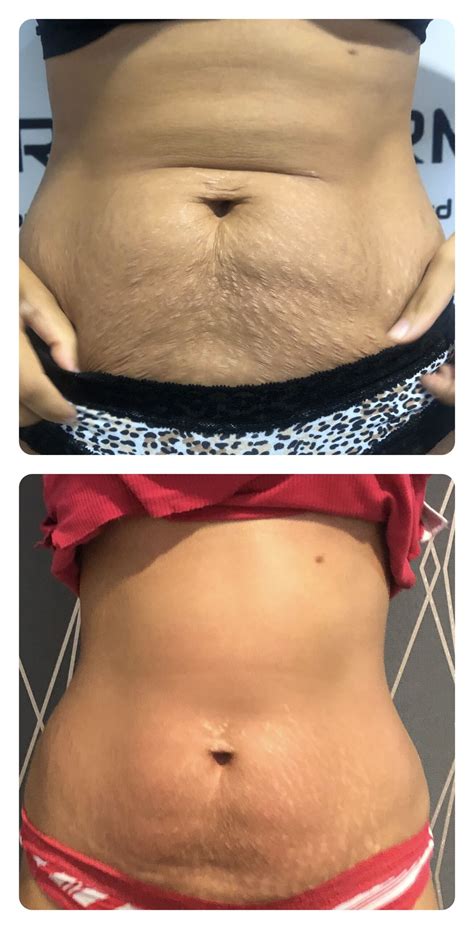 Non Surgical Tummy Tuck