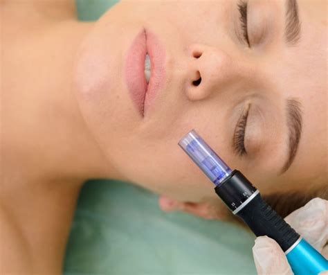 dermapen efekty mezoterapia mikroiglowa dermapenem