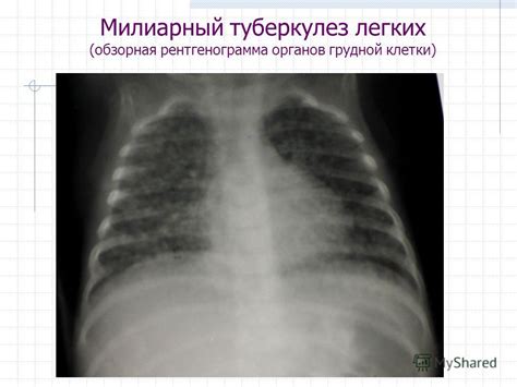 Презентация на тему: "Милиарный туберкулез легких (обзорная ...