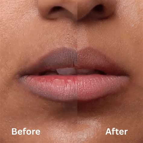 pigmented lips  winter  symptoms treatments