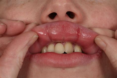 inflamed lips  gums lipstutorialorg