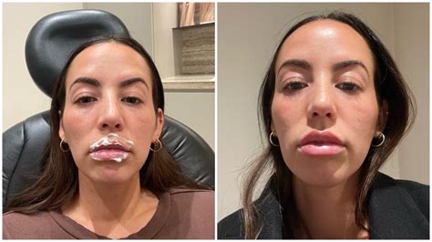 how much is it to get lip filler dissolved