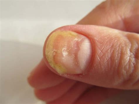 What is onycholysis and how to treat it?