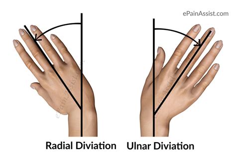pain  thumb flexion  ulnar deviation  isabella jarred blog