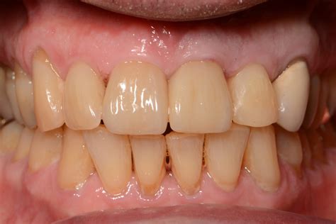 Dental Implants | Pacific Spirit Dental, Vancouver