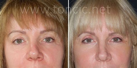 Blefaroplastika | Poliklinika dr. Tončić