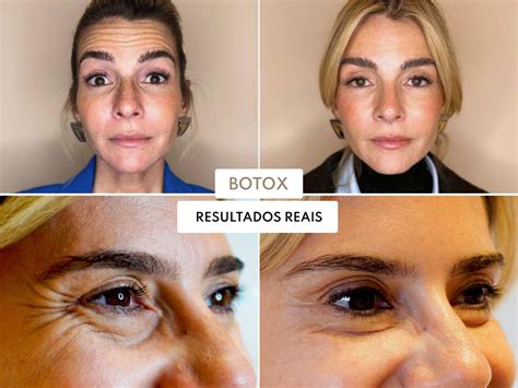 Estetica Pode Fazer Botox - 6