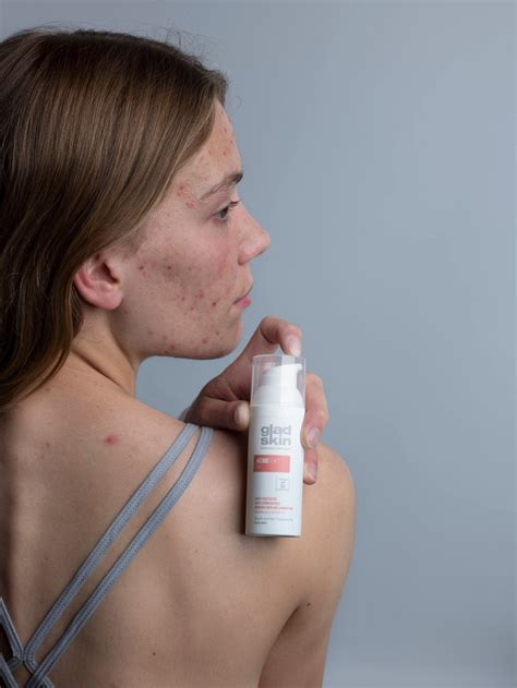 Akne Gel gegen Entzündungen & Akne Symptome | Gladskin