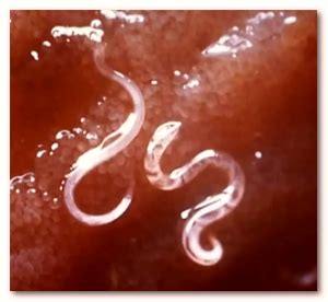 Worms in human feces - Pictures, Types, Symptoms, Treatment