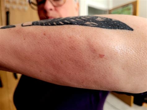 Darier_roussy sarcoidosis : r/sarcoidosis