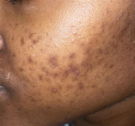 [Before&After] [Acne] : r/SkincareAddiction