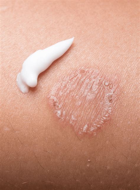 Bacterial Skin Infections | Thomson Medical