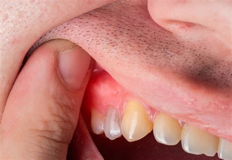 Energency Dental Abscess Treatment | Amitis Dental Studio