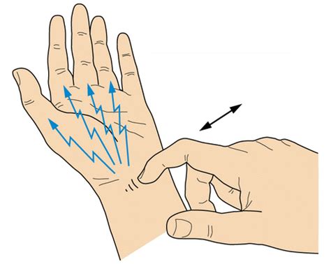 Tinel Sign | Epomedicine