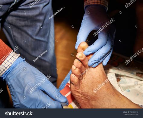 Diabetic Toenails Images: Browse 260 Stock Photos & Vectors Free ...