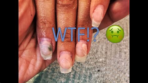 Green Fungus On Nails - Nail Fungus Information Prevention And Treatment Disabled World : I look ...