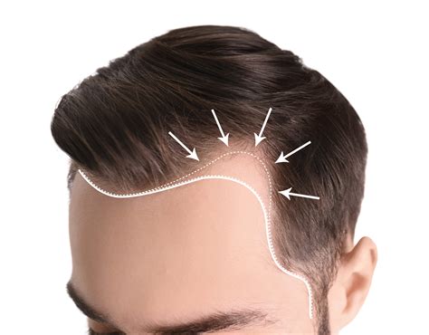 receding hairline  prevention treatment  beforeafter estenove
