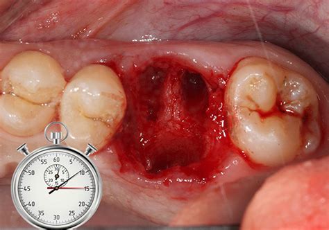 Cicatrização Da Gengiva Após Extração - Quanto tempo a gengiva cicatriza após a extração do dente e é possível ...