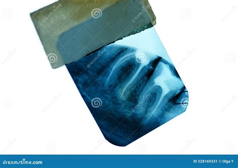 X-ray of the tooth roots stock image. Image of disease - 228169331