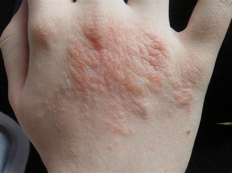 Uczulenie?. Strona 1. ForumDermatologiczne.pl – portal wiedzy o ...